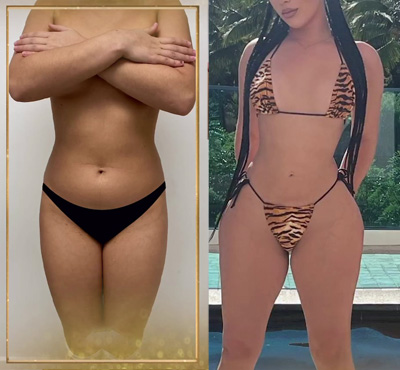 icon instagram post tummy tuck